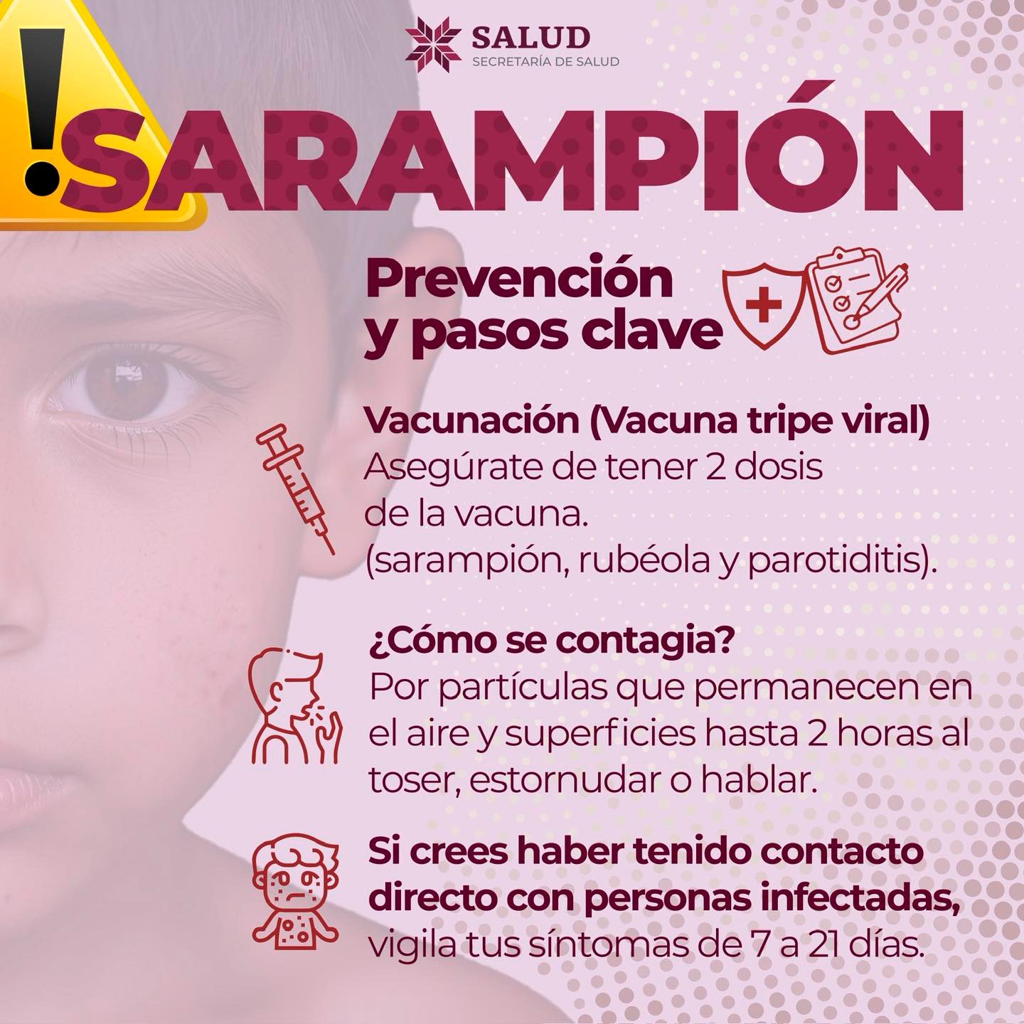 Alertan sobre prevención del sarampión en Hidalgo